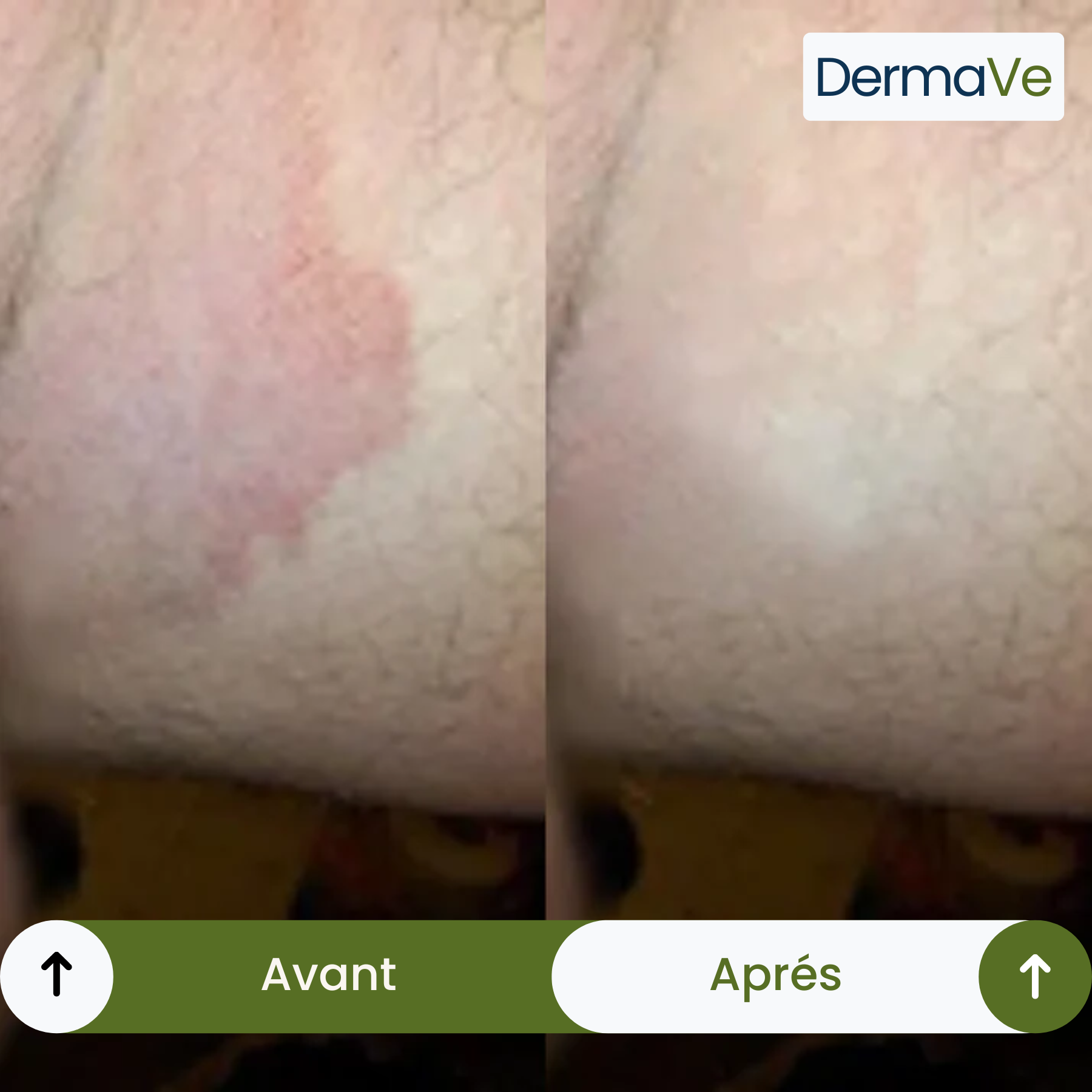 DermaVe® Cure Anti-Mycoses