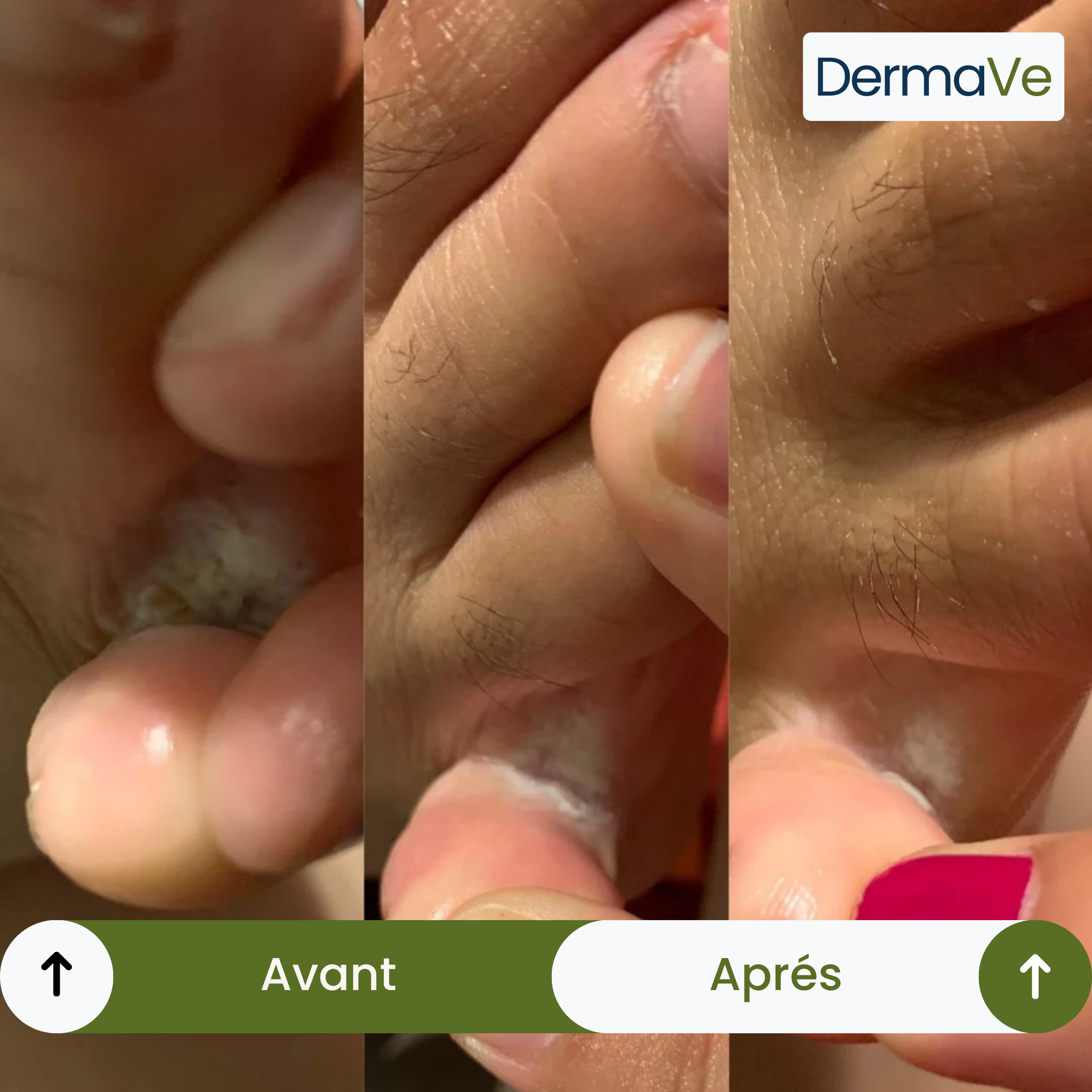 Savon DermaVe® Anti-Mycoses
