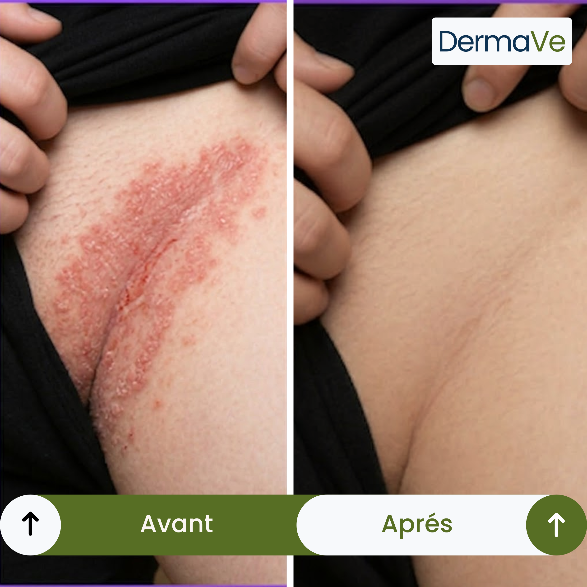 DermaVe® Savon Anti-Mycoses