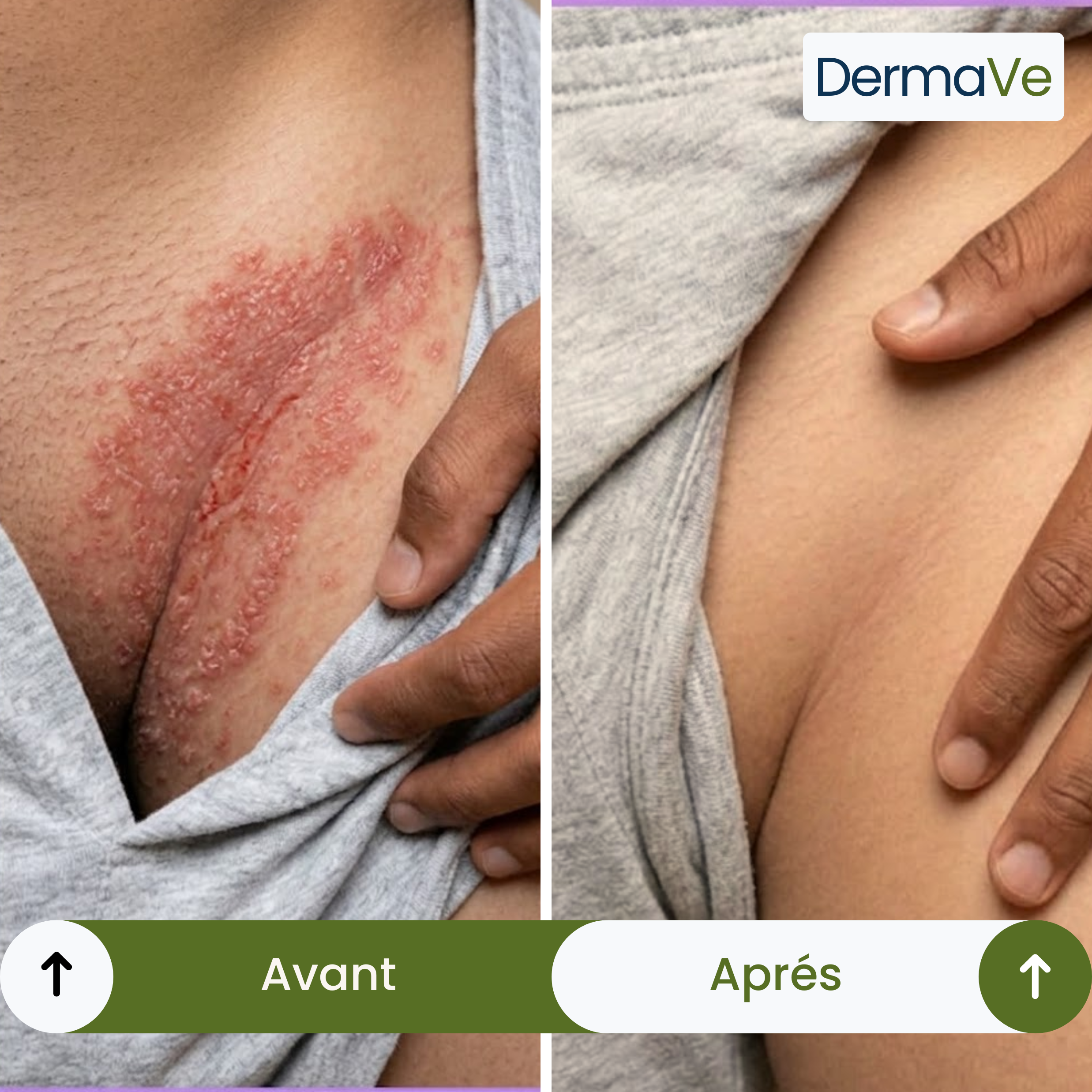 DermaVe® Savon Anti-Mycoses