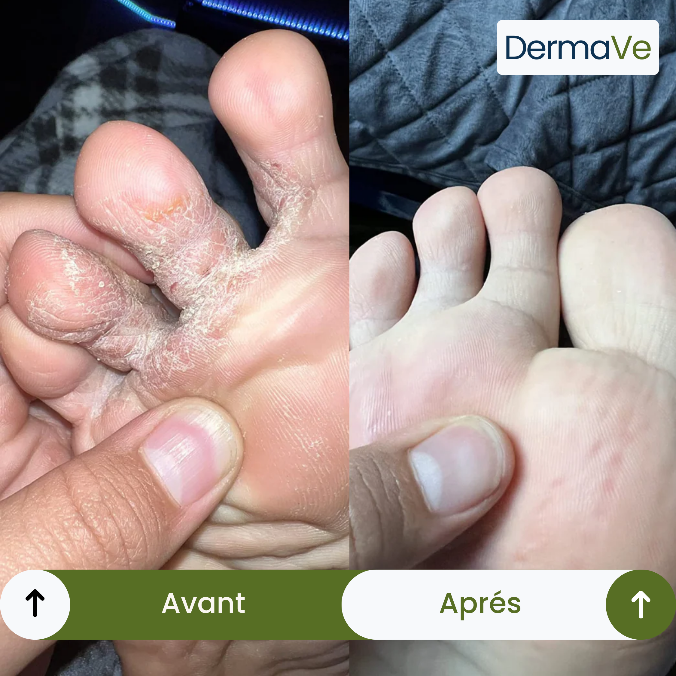 Savon DermaVe® Anti-Mycoses